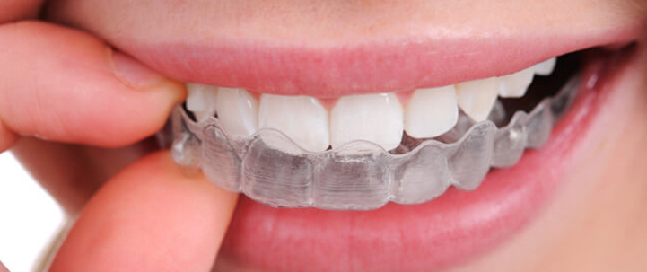 mouth guard at avant dental clinic kolkata