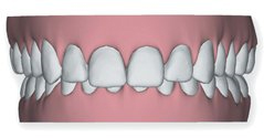 overbite invisible brace at avant dental clinic kolkata