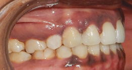 post1 treatment at avant dental clinic kolkata