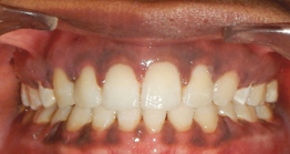 post2 treatment at avant dental clinic kolkata