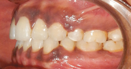 post3 treatment at avant dental clinic kolkata