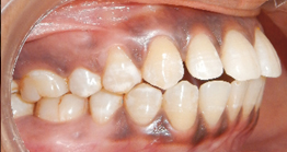 pre1 treatment at avant dental clinic kolkata