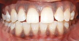 pre2 treatment at avnat dental clinic kolkata