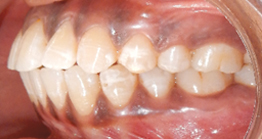 pre3 treatment at avant dental clinic kolkata