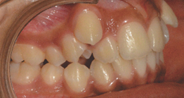 pre_teeth treatment at avant dental clinic kolkata