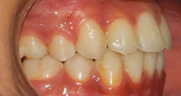pre_teeth1 treatment at avant dental clinic kolkata