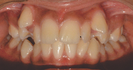 pre_teeth2 before oral treatment at avant dental clinic kolkata