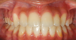 pre_teeth2_1 oral treatment at avant dental clinic kolkata