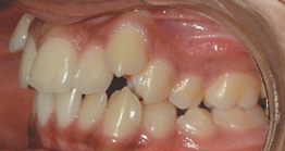 pre_teeth3 oral treatment at avant dental clinic kolkata