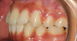 pre_teeth3_1 oral treatment at avant dental clinic kolkata