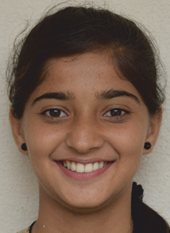 pre_treatment2_1 oral treatment at avant dental clinic kolkata