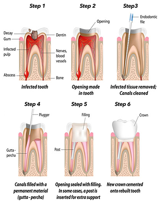 root canal treatment at avant dental clinic kolkata