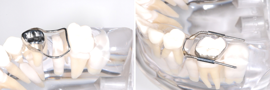 space-maintainer3 space maintain treatment at avant dental clinic kolkata