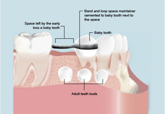 space maintain treatment at avant dental clinic kolkata