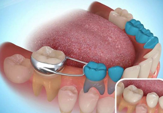 space maintain treatment at avant dental clinic kolkata