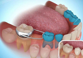 space4 space maintain treatment at avant dental clinic kolkata