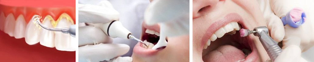 teeth cleaning at avant dental clinic kolkata