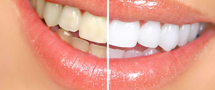 teeth whitening before and after at avant dental clinic kolkata