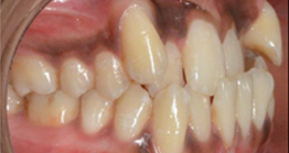 teeth1 before treatment at avant dental clinic kolkata