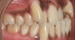 before treatment at avant dental clinic kolkata