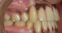 teeth_1_1 after treatment at avant dental clinic kolkata
