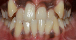 before treatment at avant dental clinic kolkata