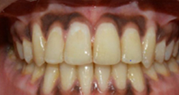 teeth_2_2 after teeth treatment at avant dental clinic kolkata