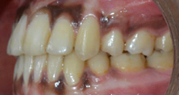 teeth_3_3 after teeth treatment at avant dental clinic kolkata