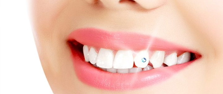 custom jewelry made teeth at avant dental clinic kolkata