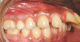 treatment1 treatment at avant dental clinic kolkata