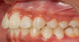 treatment10_10 oral treatment a avant dental clinic kolkata