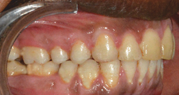 treatment1_1 treatment at avant dental clinic kolkata