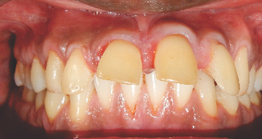 treatment2 treatment at avant dental clinic kolkata