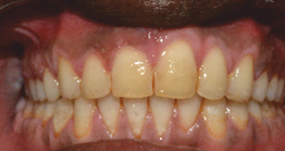 oral treatment at avant dental clinic kolkata