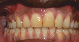 treatment2_2 oral treatment at avant dental clinic kolkata