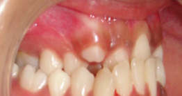 before treatment at avant dental clinic kolkata