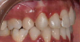 treatment3_3 treatment at avant dental clinic kolkata