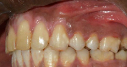 treatment3_3 oral treatment at avant dental clinic kolkata