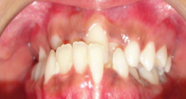 before treatment at avant dental clinic kolkata