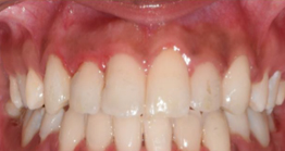 treatment4_4 after treatment at avant dental clinic kolkata