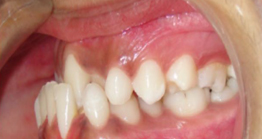 before treatment at avant dental clinic kolkata