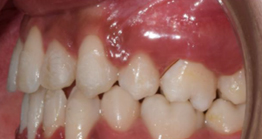 treatment5_5 after treatment at avant dental clinic kolkata
