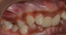 treatment8 oral treatment at avant dental clinic kolkata