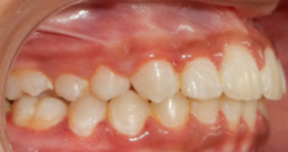 treatment8_8 oral treatment at avant dental clinic kolkata