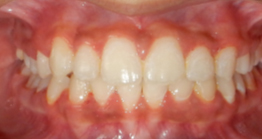 oral treatment at avant dental clinic kolkata