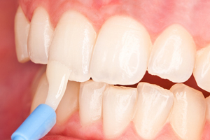 floride treatment at avant dental clinic kolkata