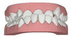 underbite invisible brace at avant dental clinic kolkata