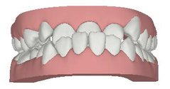 invisible brace at avant dental clinic kolkata