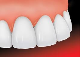 tooth veneer at avant dental clinic kolkata