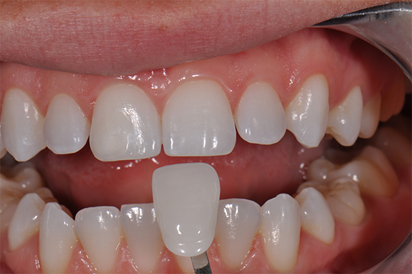 tooth veneer treatment at avant dental clinic kolkata